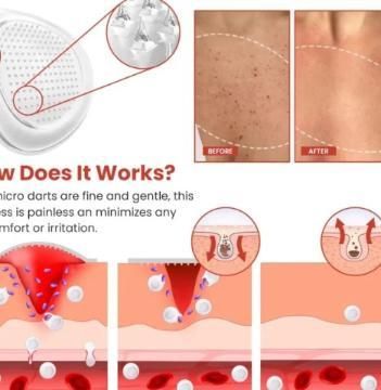 Skin Tag Remover Patch- provides safe removal.
